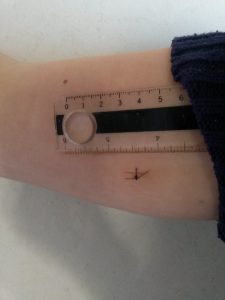 contraccettivo sottocutaneo wireless