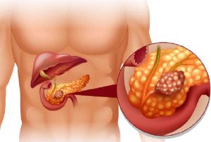 Tumore al pancreas