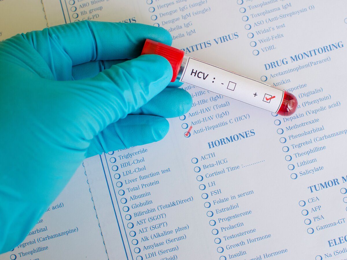 Hepatitis C virus (HCV) positive