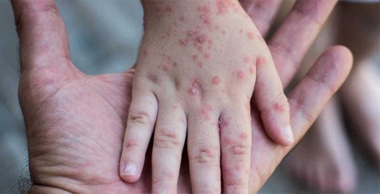 Vaiolo delle scimmie.