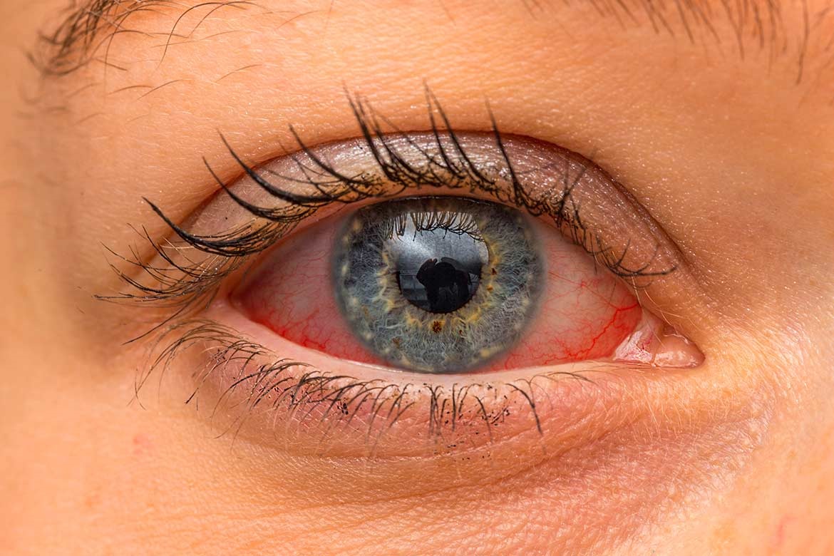 Occhi rossi dopo il mare