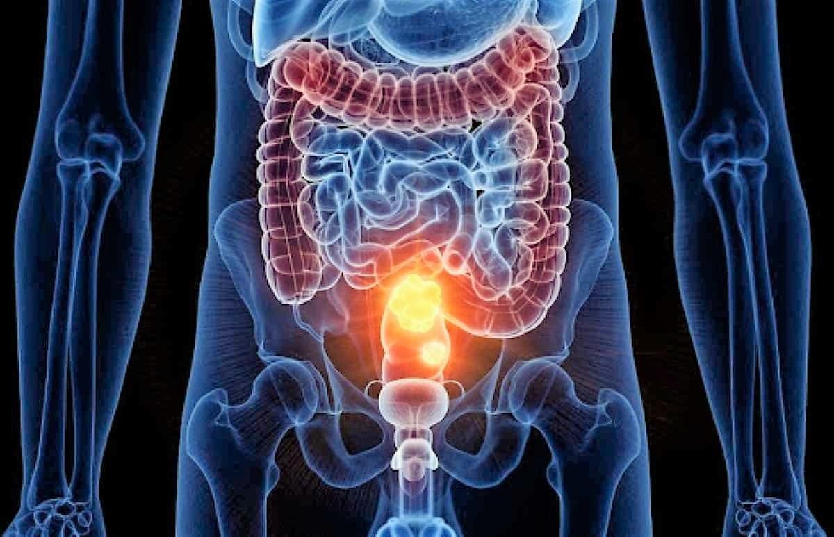 Tumore al colon