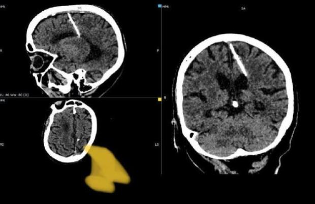Ha un ago conficcato nel cervello, la scoperta choc a 80 anni: il motivo è inquietante