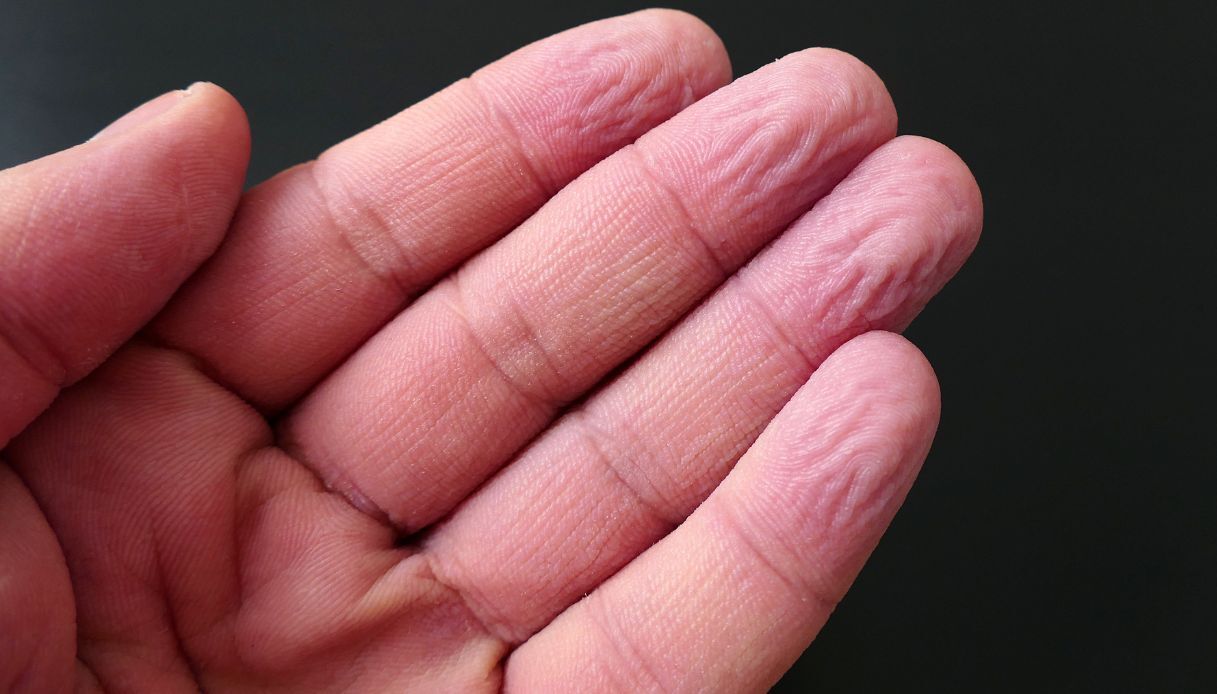 Dita che raggrinziscono