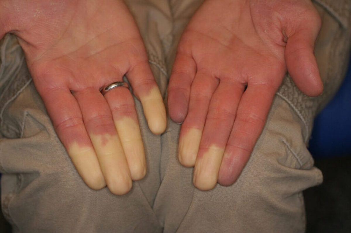 Malattia di Raynaud