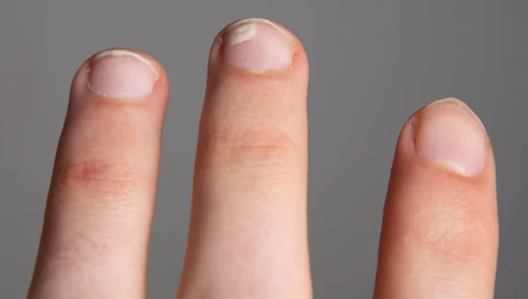 Tumori unghie_Donnaclick