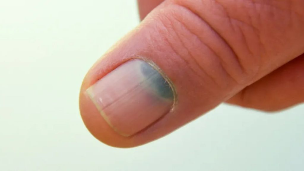 Tumori unghie_Donnaclick