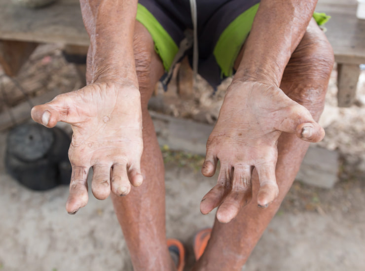 Lebbra Europa_Donnaclick