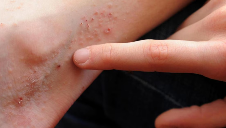 Porfiria malattia Dracula_Donnaclick